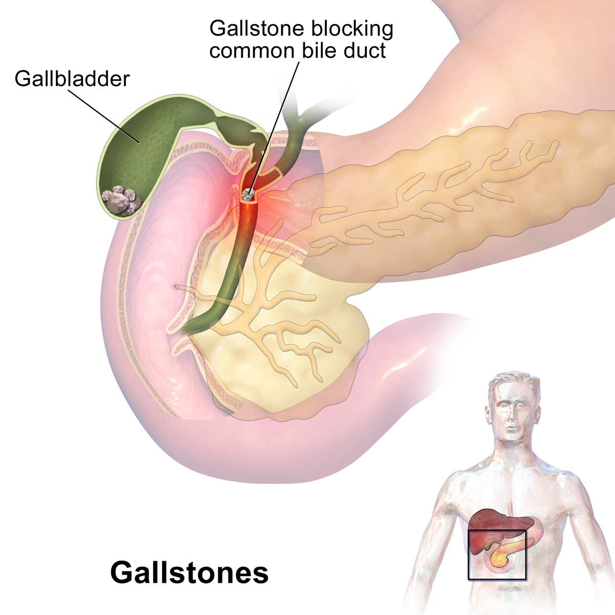 Gallbladder Removal Private Surgeon Milton Keynes