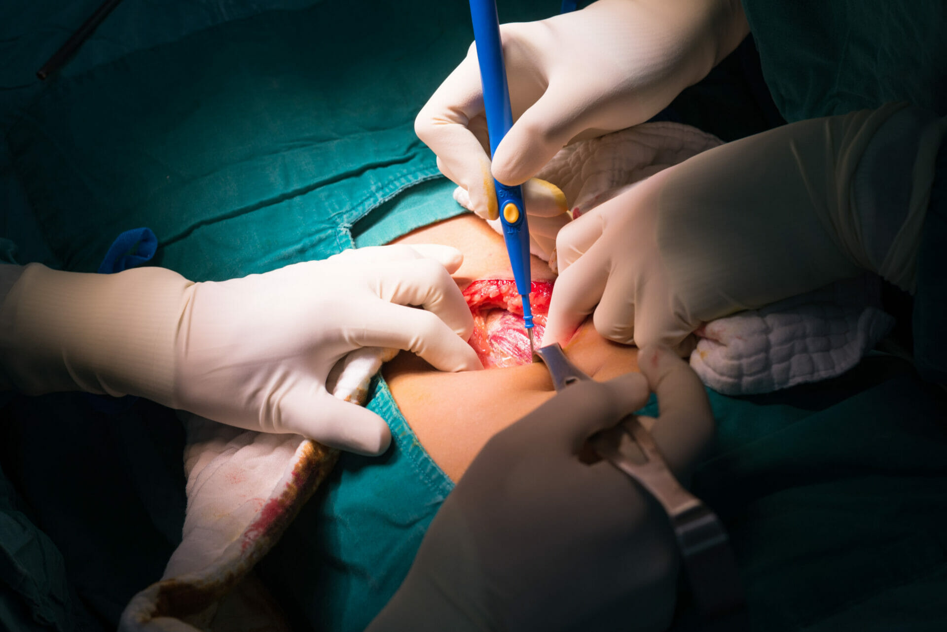 appendoctomy appendoctomy